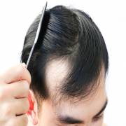 hairtransplantation