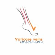 varicose2